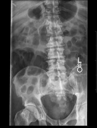 Simon nitinol IVC filter | Radiology Case | Radiopaedia.org