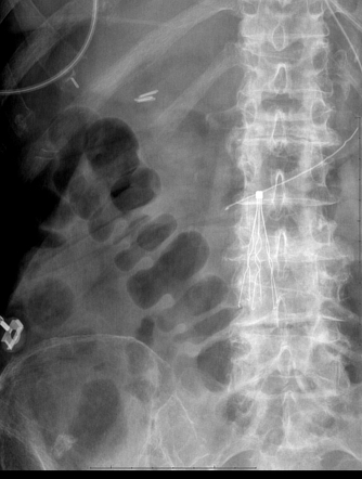 Inferior Vena Cava Filter | Radiology Reference Article | Radiopaedia.org