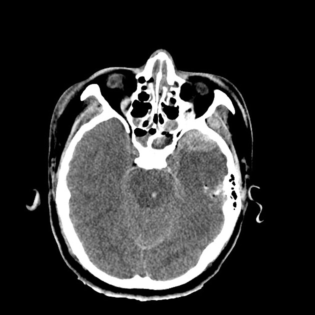 Mandibular nerve - wikidoc