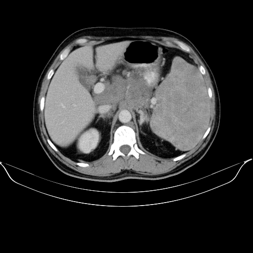 Hodgkin lymphoma | Image | Radiopaedia.org