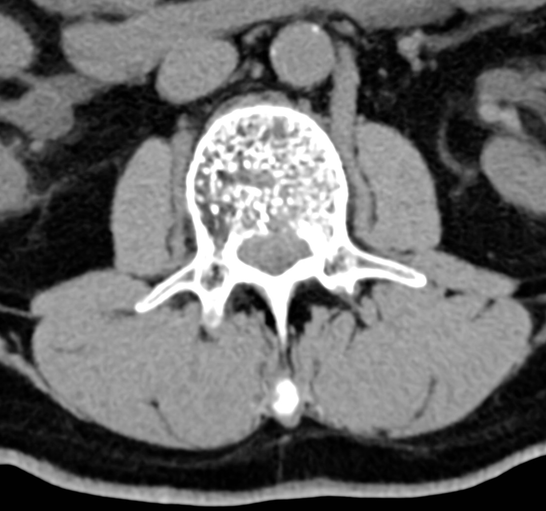 Aggressive spinal hemangioma | Image | Radiopaedia.org