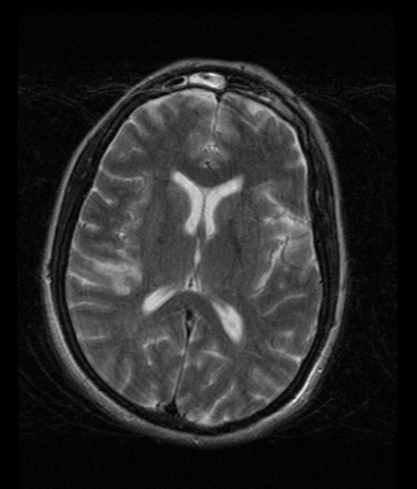 Right MCA territory infarct | Image | Radiopaedia.org