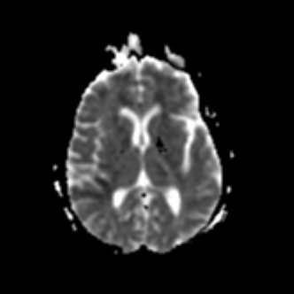 Right MCA territory infarct | Image | Radiopaedia.org