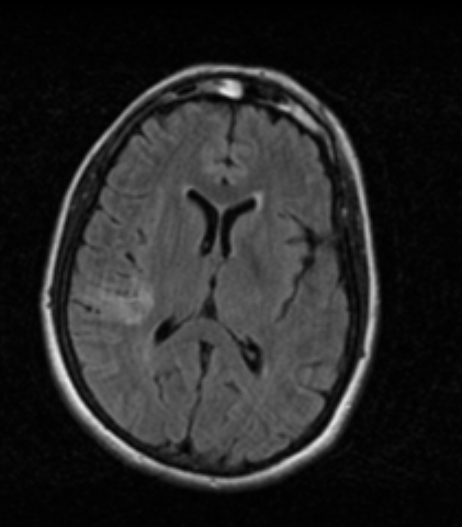 Right MCA territory infarct | Image | Radiopaedia.org