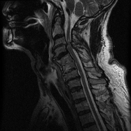 Cervical Spinal Canal Stenosis