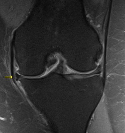 Meniscal extrusion | Radiology Reference Article | Radiopaedia.org