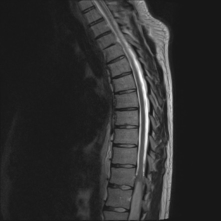 Lumbar spine ependymoma (WHO grade 2) | Image | Radiopaedia.org