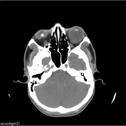 Staphyloma | Radiology Reference Article | Radiopaedia.org