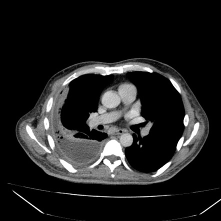 Pleural empyema | Radiology Case | Radiopaedia.org