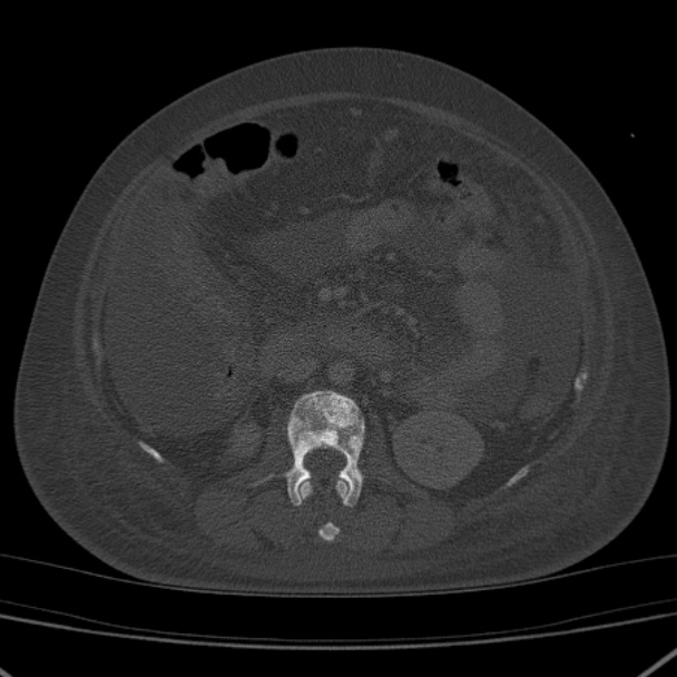 Breast Cancer Metastases - Hepatic And Skeletal | Image | Radiopaedia.org