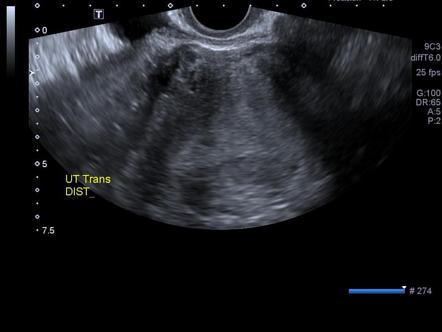 Haemorrhagic corpus luteal cyst | Radiology Case | Radiopaedia.org