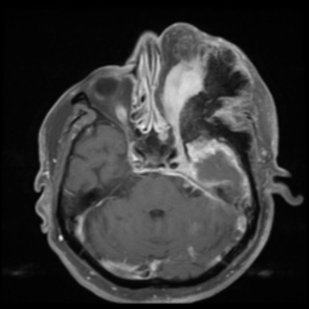 Intraosseous meningioma | Radiology Reference Article | Radiopaedia.org