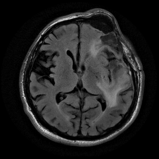 Intraosseous meningioma | Image | Radiopaedia.org