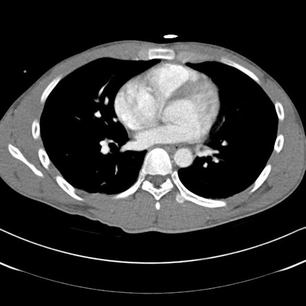 Liver laceration - AAST grade V | Radiology Case | Radiopaedia.org