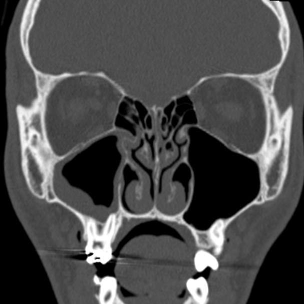 Depressed fracture of the anterior wall of the right maxillary sinus ...