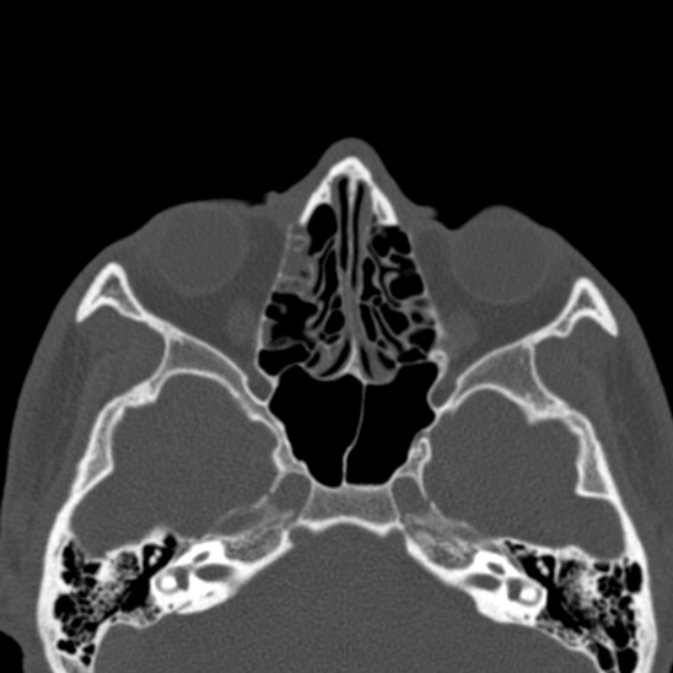 Depressed fracture of the anterior wall of the right maxillary sinus ...