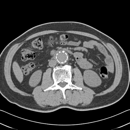 Endovascular aneurysm repair | Radiology Reference Article ...