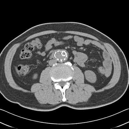 Endovascular aortic repair | Radiology Case | Radiopaedia.org