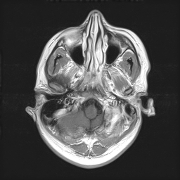 Sellar and suprasellar meningioma | Image | Radiopaedia.org