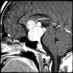 Sellar and suprasellar meningioma | Image | Radiopaedia.org