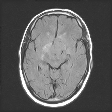 Sellar and suprasellar meningioma | Image | Radiopaedia.org