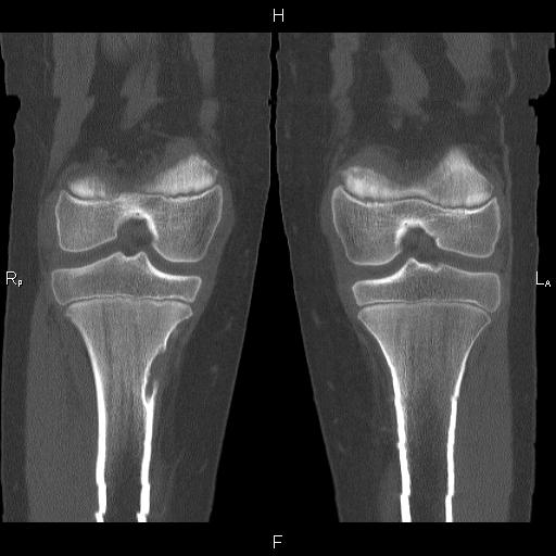 fibrous-cortical-defect-image-radiopaedia