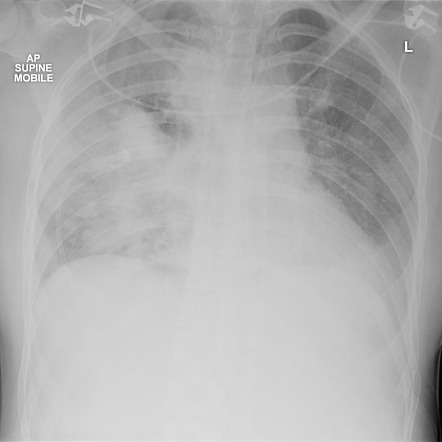 Penetrating thoracic trauma | Radiology Reference Article | Radiopaedia.org