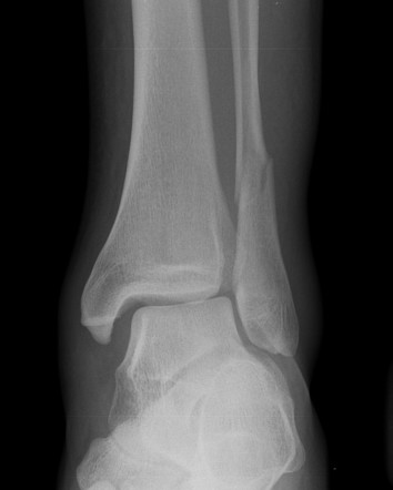 Weber classification of ankle fractures | Radiology Reference Article ...