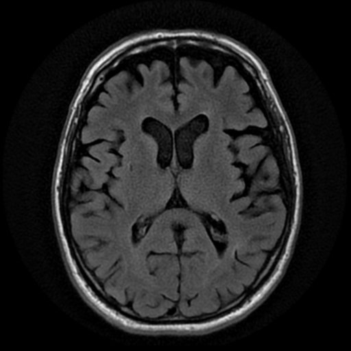 Facial nerve schwannoma and nasal polyp | Image | Radiopaedia.org