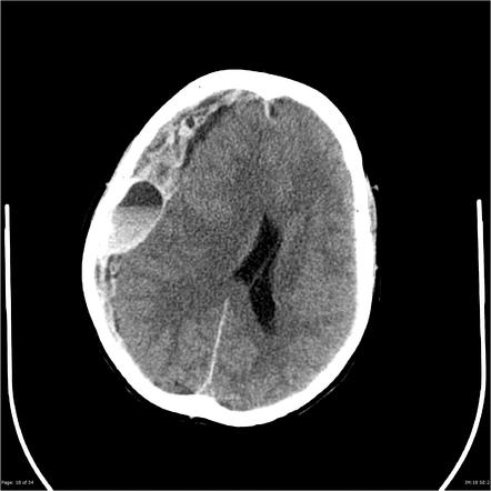 Post-dural puncture headache | Radiology Reference Article ...