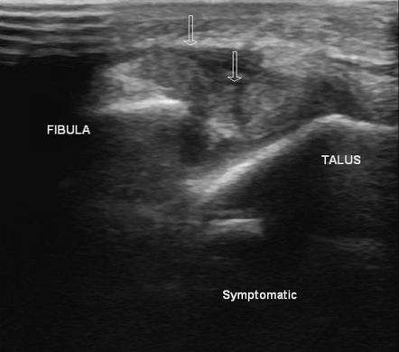 Anterior talofibular ligament injury | Radiology Case | Radiopaedia.org