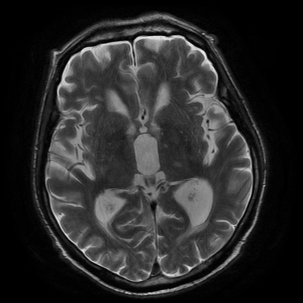 Normal pressure hydrocephalus | Image | Radiopaedia.org