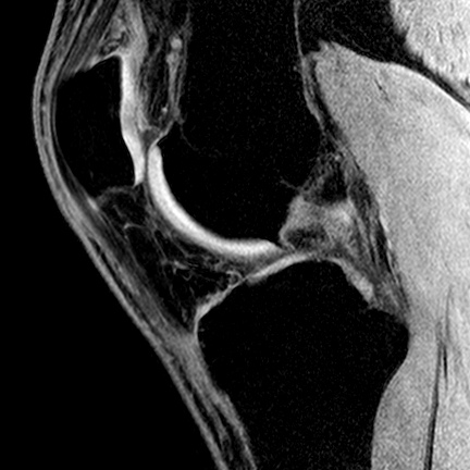 Medial plica | Image | Radiopaedia.org