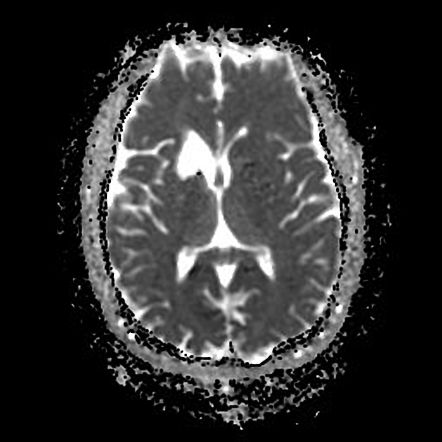 Recurrent artery of Heubner infarction - capsular warning syndrome ...