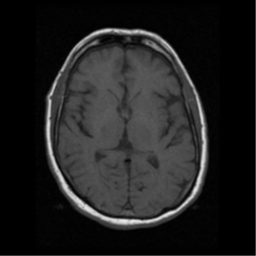 Hemorrhagic intracranial melanoma metastasis | Image | Radiopaedia.org