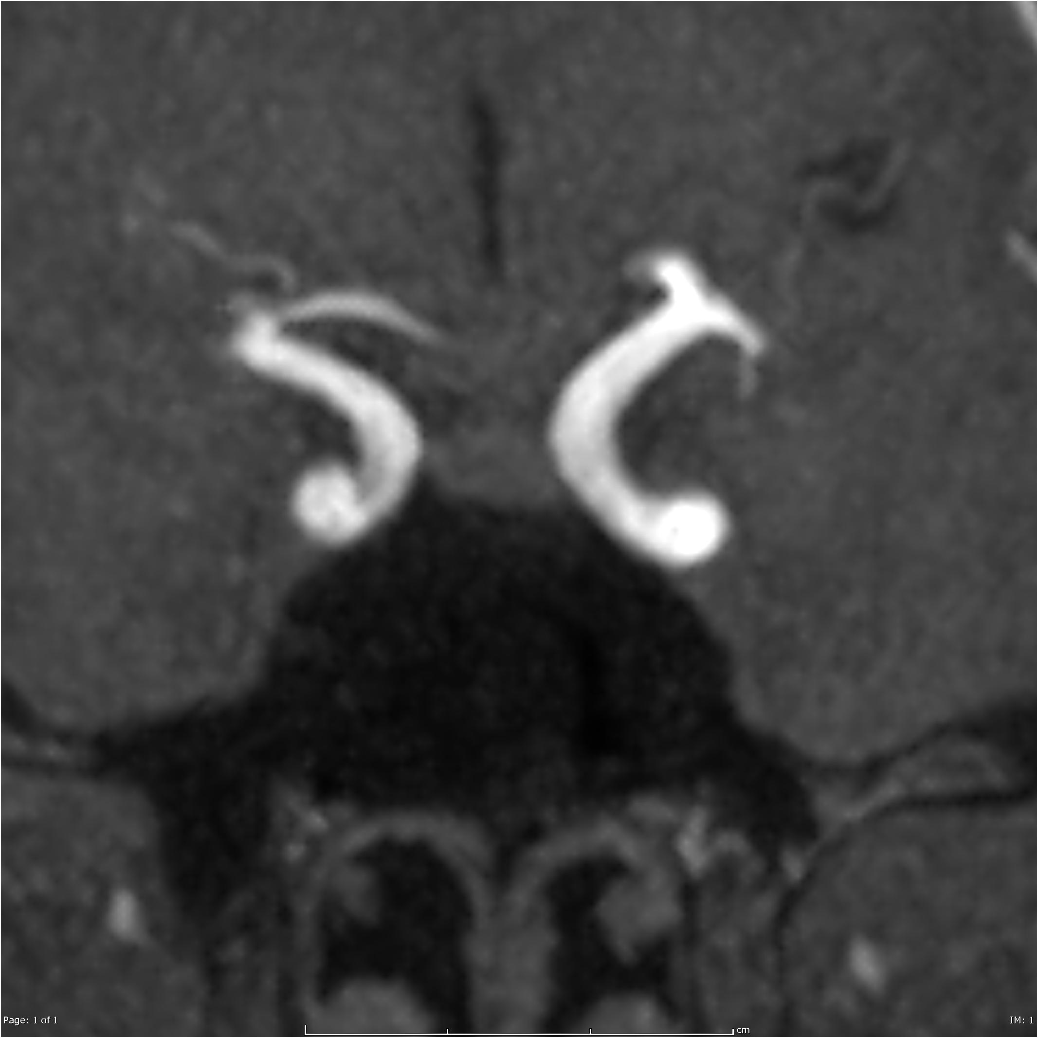 Perivascular space | Image | Radiopaedia.org