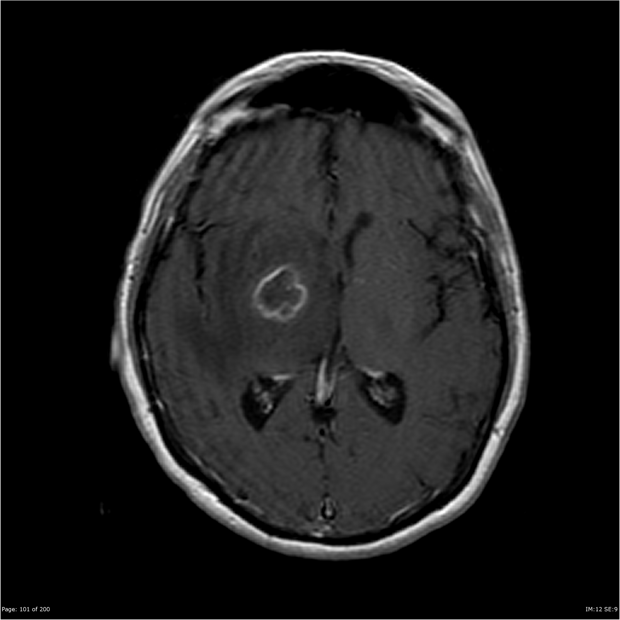 Cerebral toxoplasmosis | Image | Radiopaedia.org