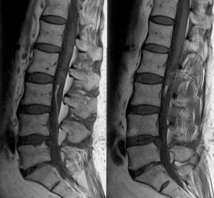 Viewing playlist: Neuro18 - Spinal lesions | Radiopaedia.org