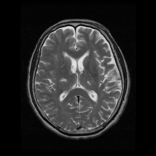 Atypical meningioma with skull invasion | Image | Radiopaedia.org