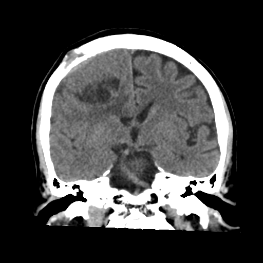 Atypical meningioma with skull invasion | Image | Radiopaedia.org