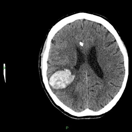 Viewing playlist: Neuroimaging - Brain | Radiopaedia.org