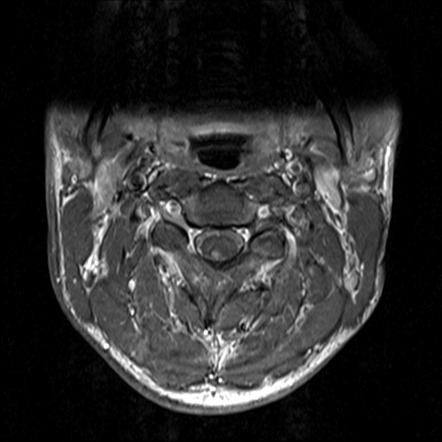 Spinal and cerebellar vermis hemangioblastomas - vHL | Image ...