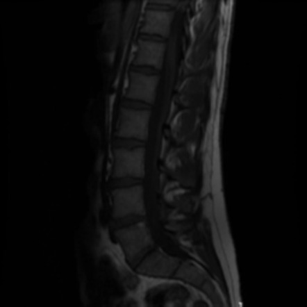 L4-5 focal right paracentral disc extrusion impinging on the descending ...