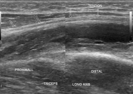 Partial rupture of triceps muscle | Image | Radiopaedia.org