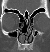 Crista galli | Radiology Reference Article | Radiopaedia.org