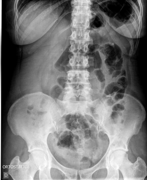 Petersen hernia, Radiology Reference Article