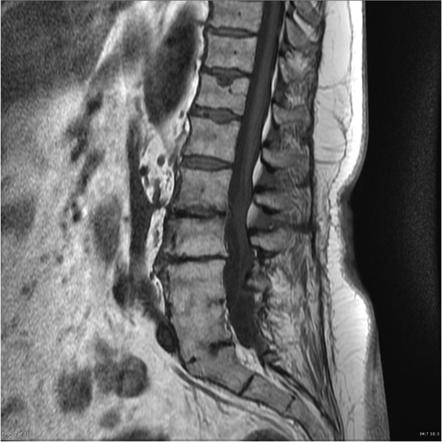 Arachnoiditis | Radiology Case | Radiopaedia.org