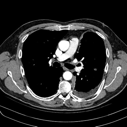 Mesothelioma | Radiology Reference Article | Radiopaedia.org