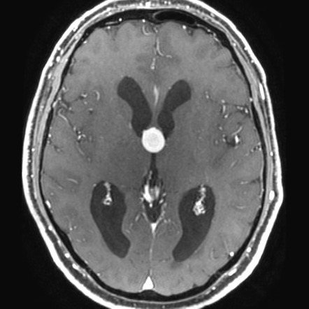 Colloid cyst (large) | Image | Radiopaedia.org