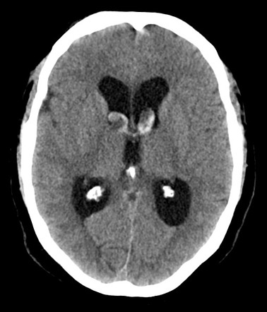 Subarachnoid hemorrhage - posterior fossa | Radiology Case ...